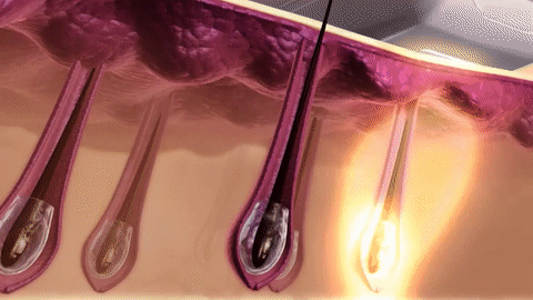 IPL Laser Hair Removal Handset IPL Laser Hair Removal Handset