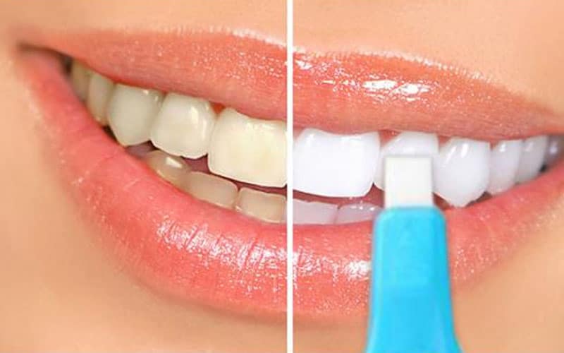 Nano Teeth Whitening Kit