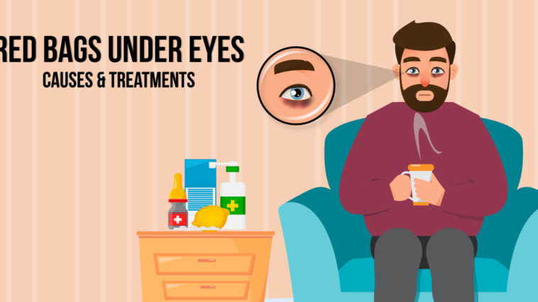 Allergic-Shiners