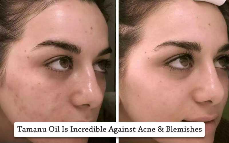 Tamanu oil for acne scars