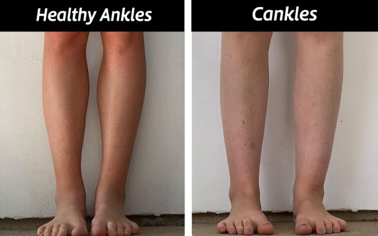 Causes How To Get Rid Of Cankles With Exercise Surgery Causes How To Get Rid Of Cankles With Exercise Surgery